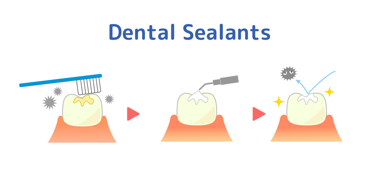 illustrations of dental sealants treatment before after